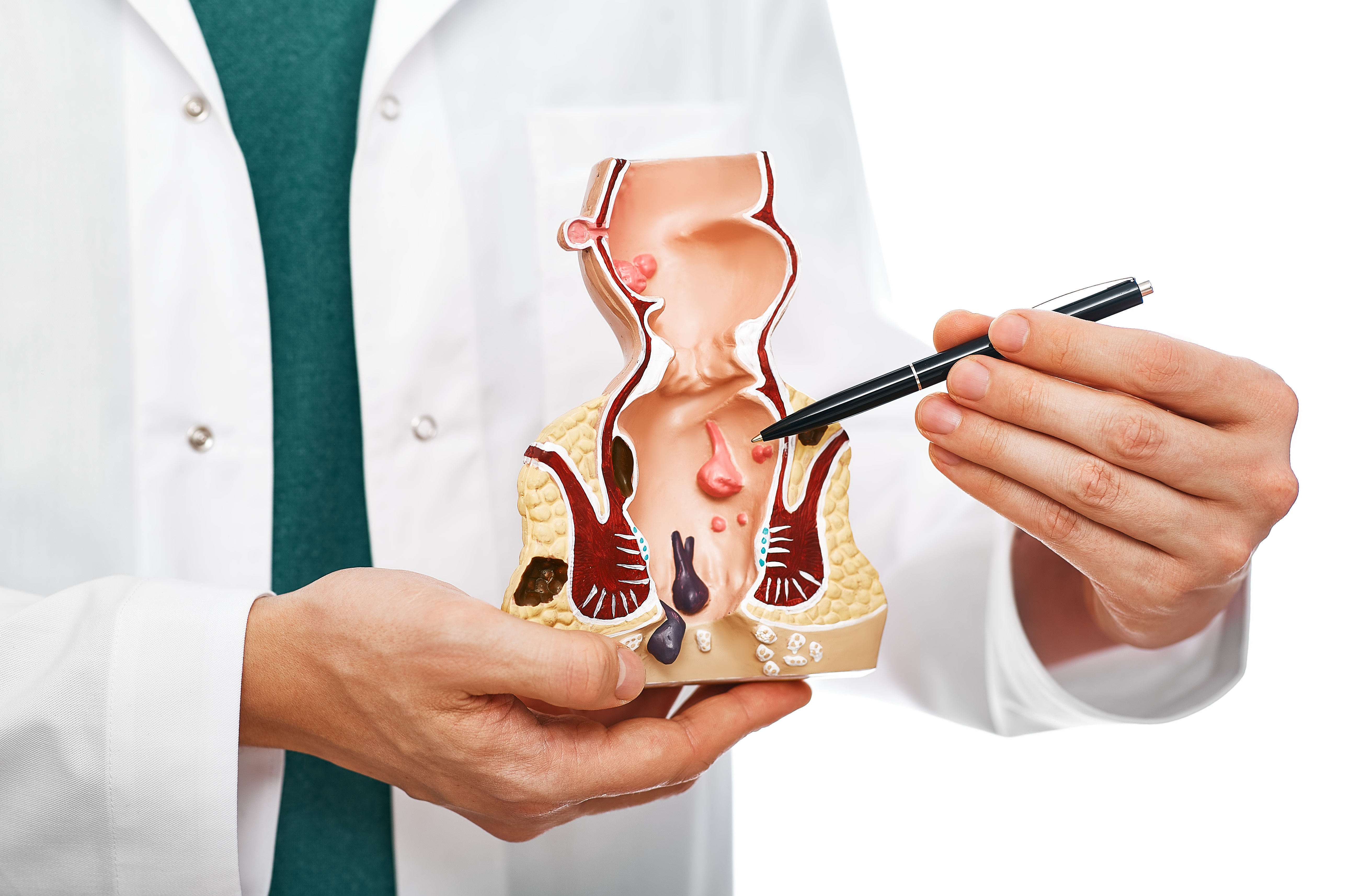 Hemoroid (Basur) Nedir? Belirtileri ve Tedavi Yöntemleri Nelerdir?