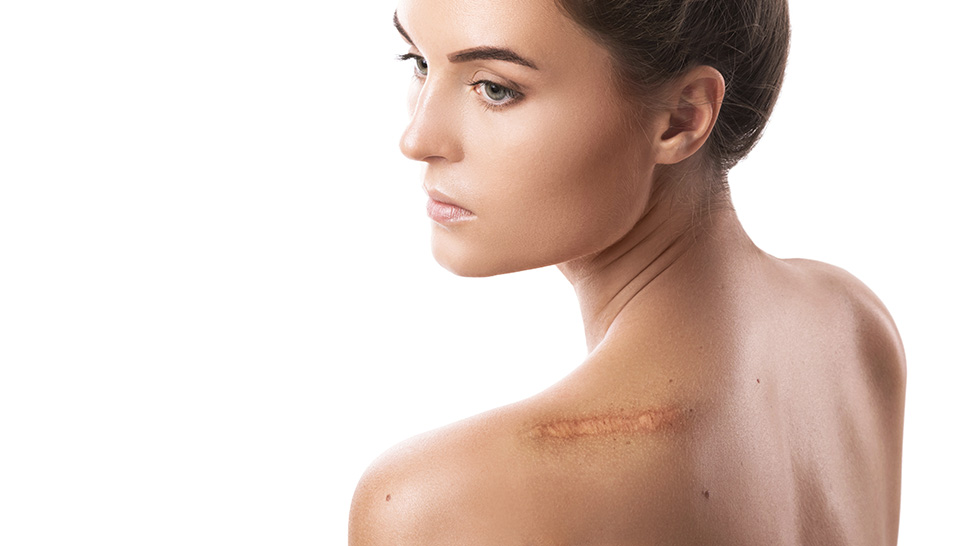 Keloid Nedir? Belirti ve Tedavi Yöntemi