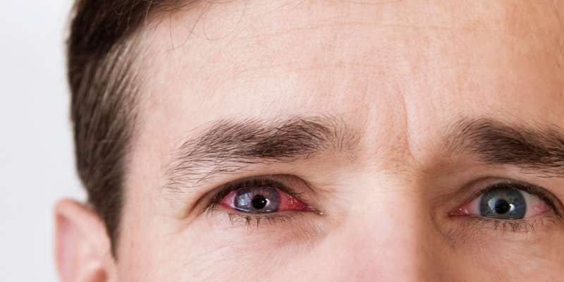 Alerjik Konjonktivit ve Kuru Göz Hastalıkları